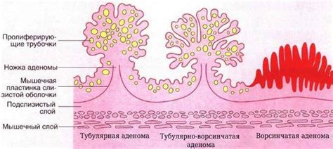 Эпителиальное образование прямой кишки: что это такое